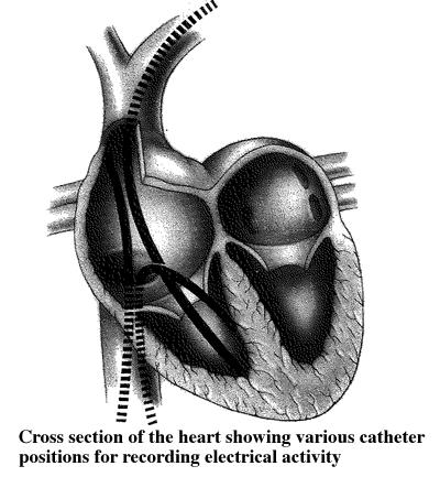 cardiac ivcd